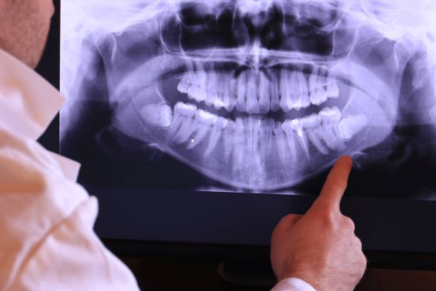 Best Emergency Root Canal Treatment in Forestville, CA