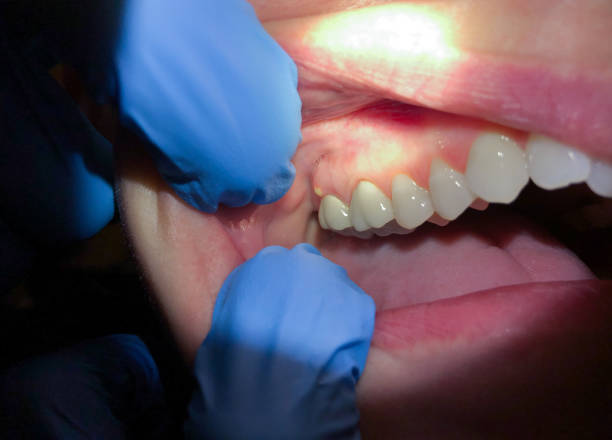 Best Emergency Dental Care for Trauma or Injury in Forestville, CA